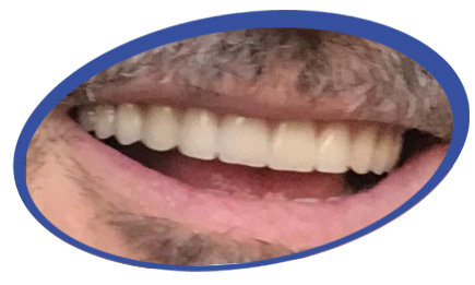 תמונות של שיניים תותבות